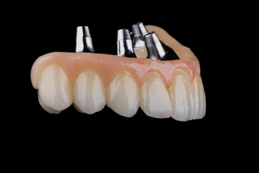 All on 4 vs All on 6 Dental Implants: Which is the best option?