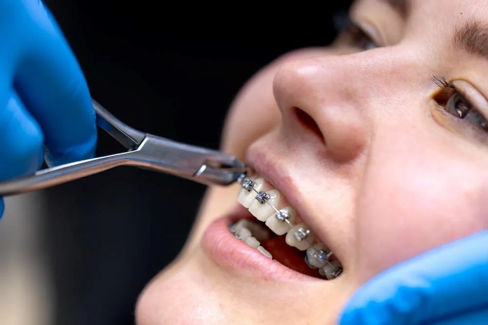 Braces Prices in Istanbul