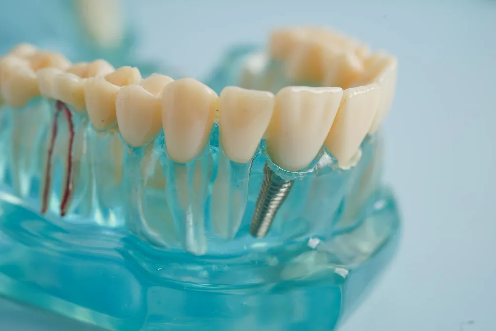Dental Implant Costs in Turkey