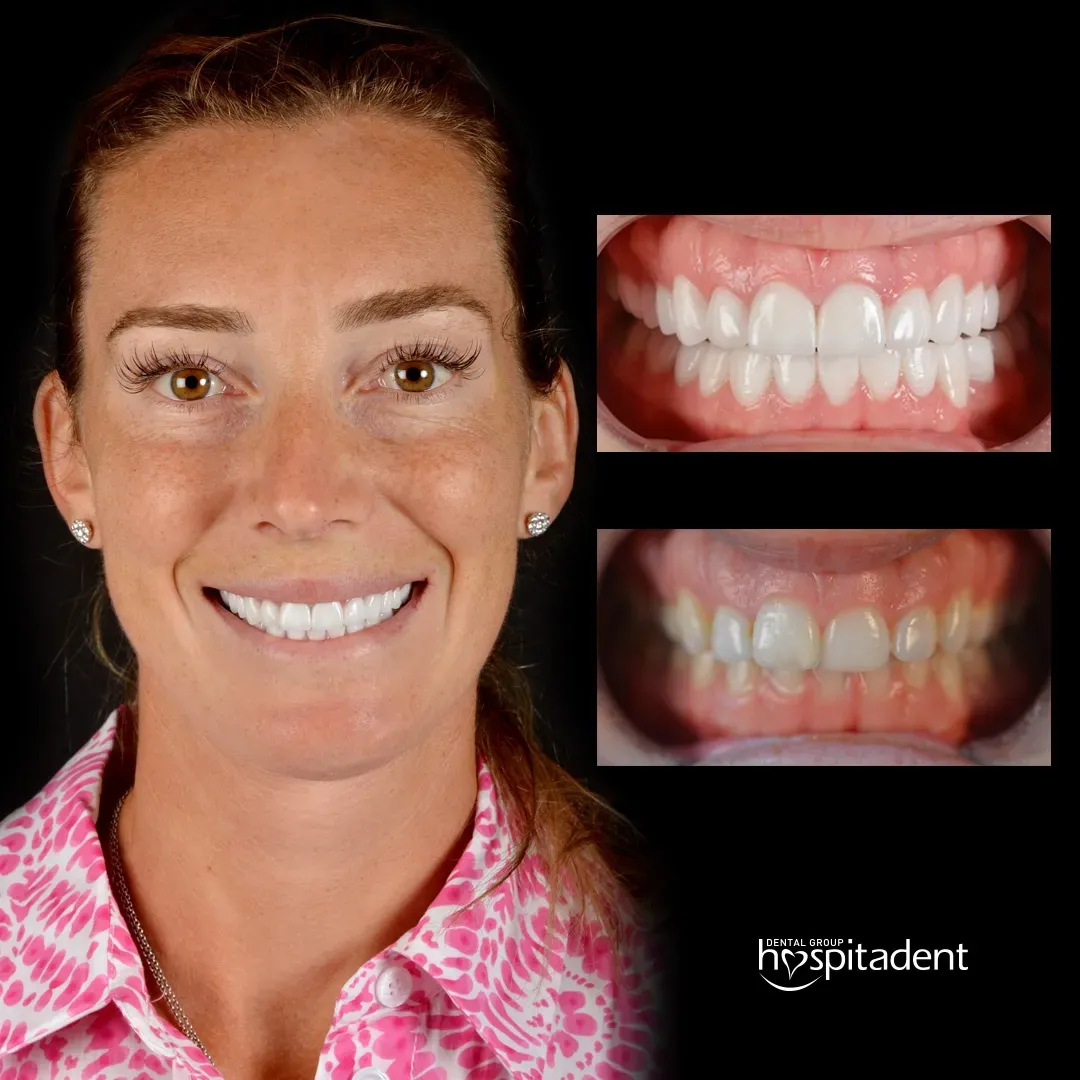 Hollywood Smile: The Complete Guide to Getting Celebrity-Style Teeth