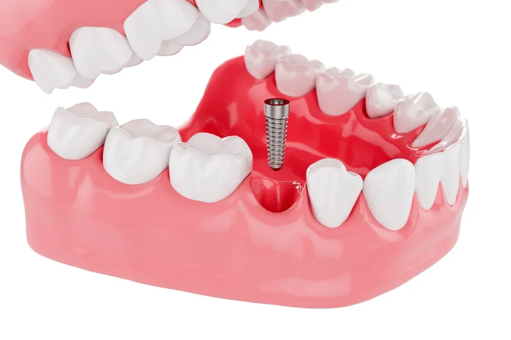 en iyi implantlar