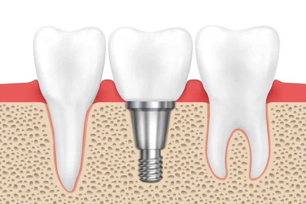 implant markaları