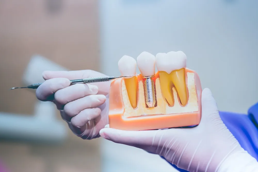 Cost of Full Dental Implants