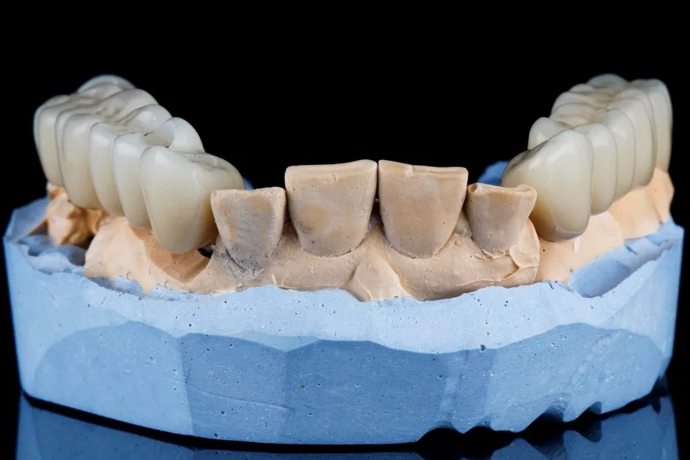 implant köprü diş farkı