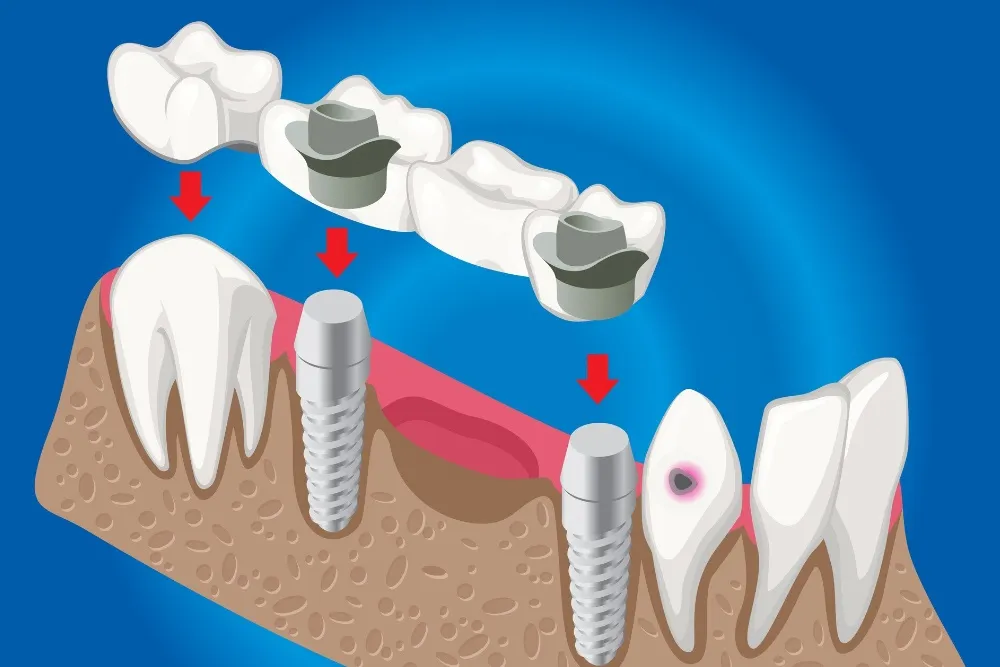 implant ve köprü diş