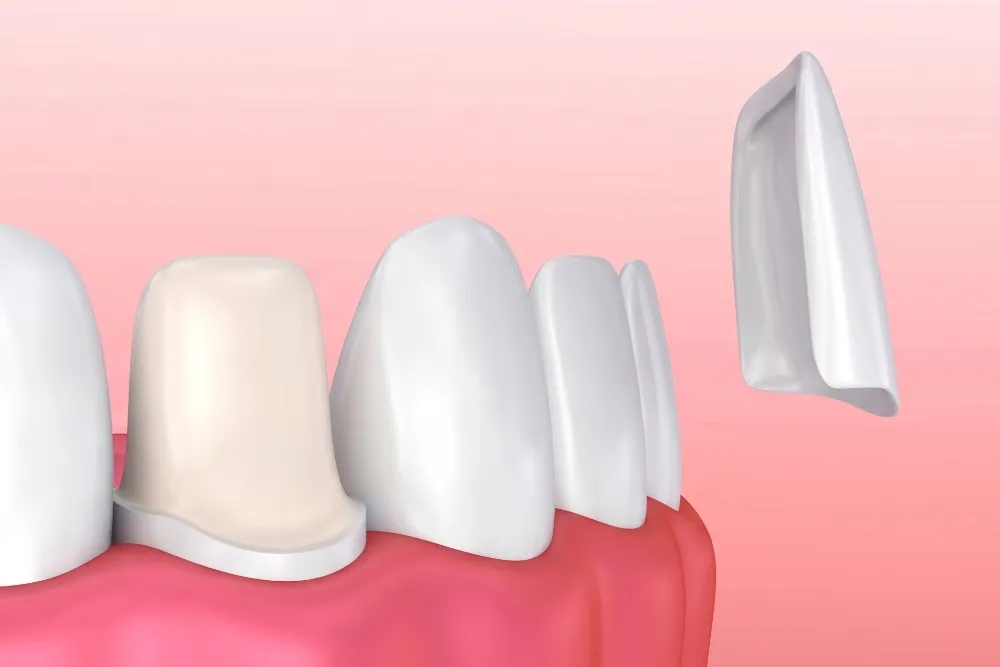 Porselen Dişlerde Cerec Uygulaması