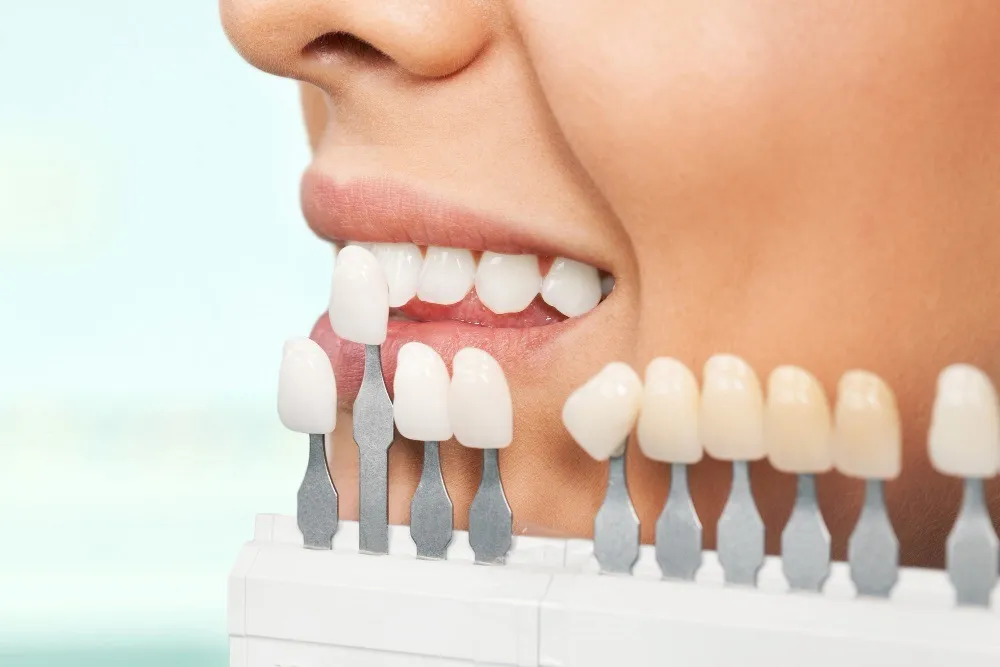 Aesthetic Smile with Porcelain Veneers