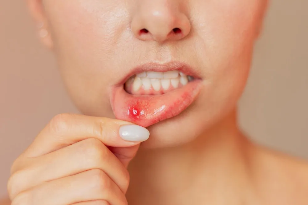 Aftas y heridas bucales