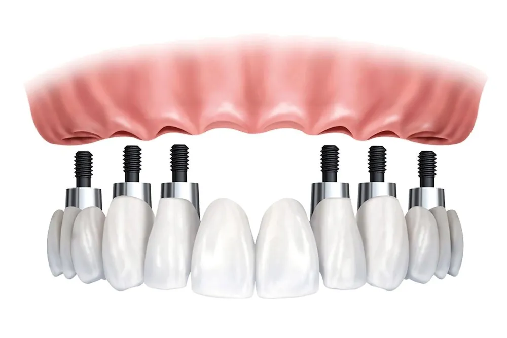 All on 4 vs All on 6 Dental Implants: Which is Best for You?