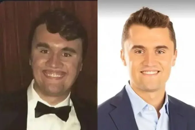 Charlie Kirk Smile: Gummy Smile Facts & Treatment