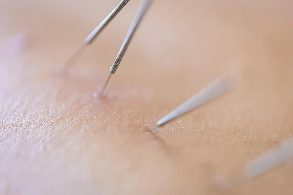 Dental Treatments with Acupuncture