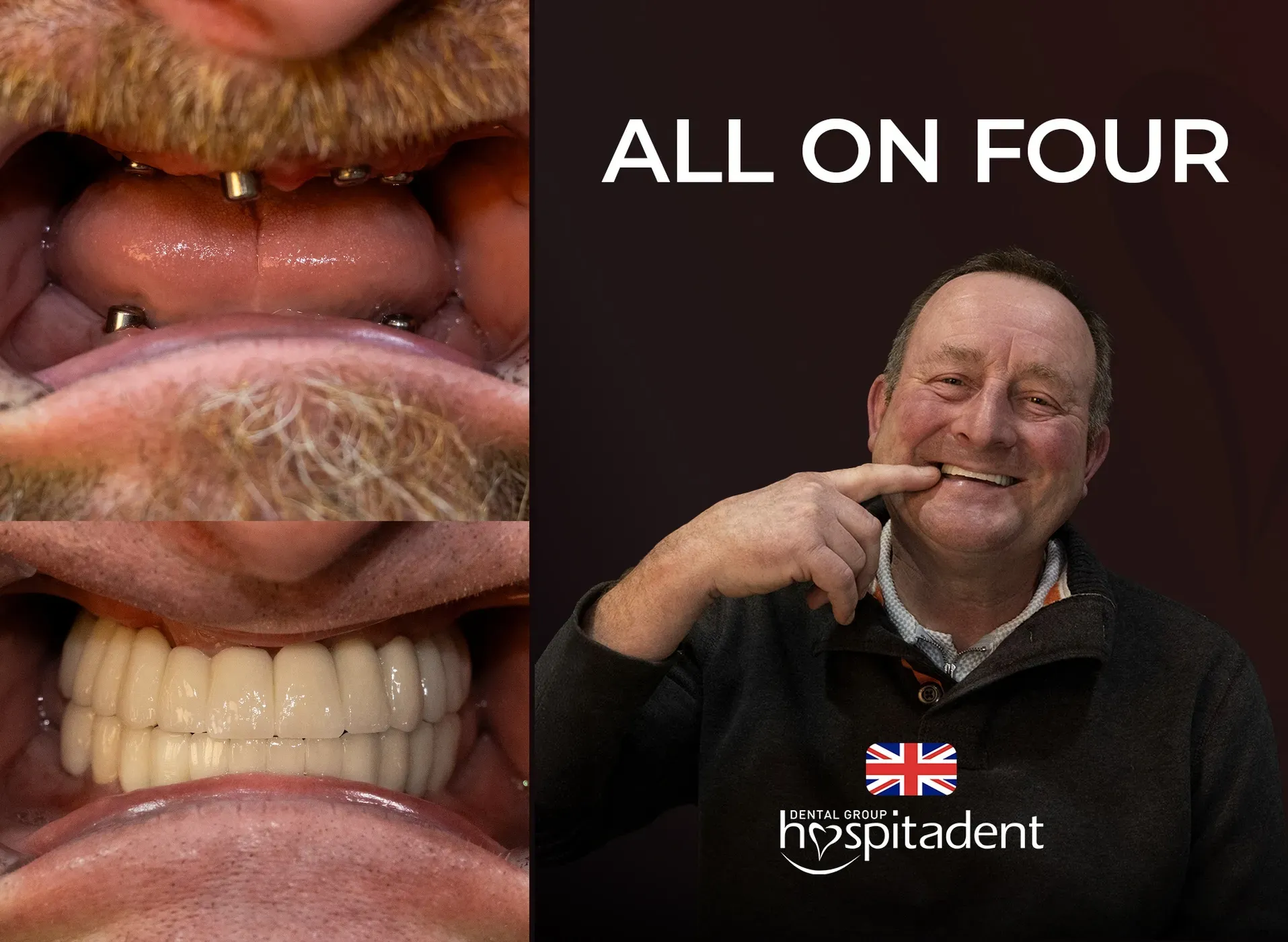 All-on-4 Dental In Implants