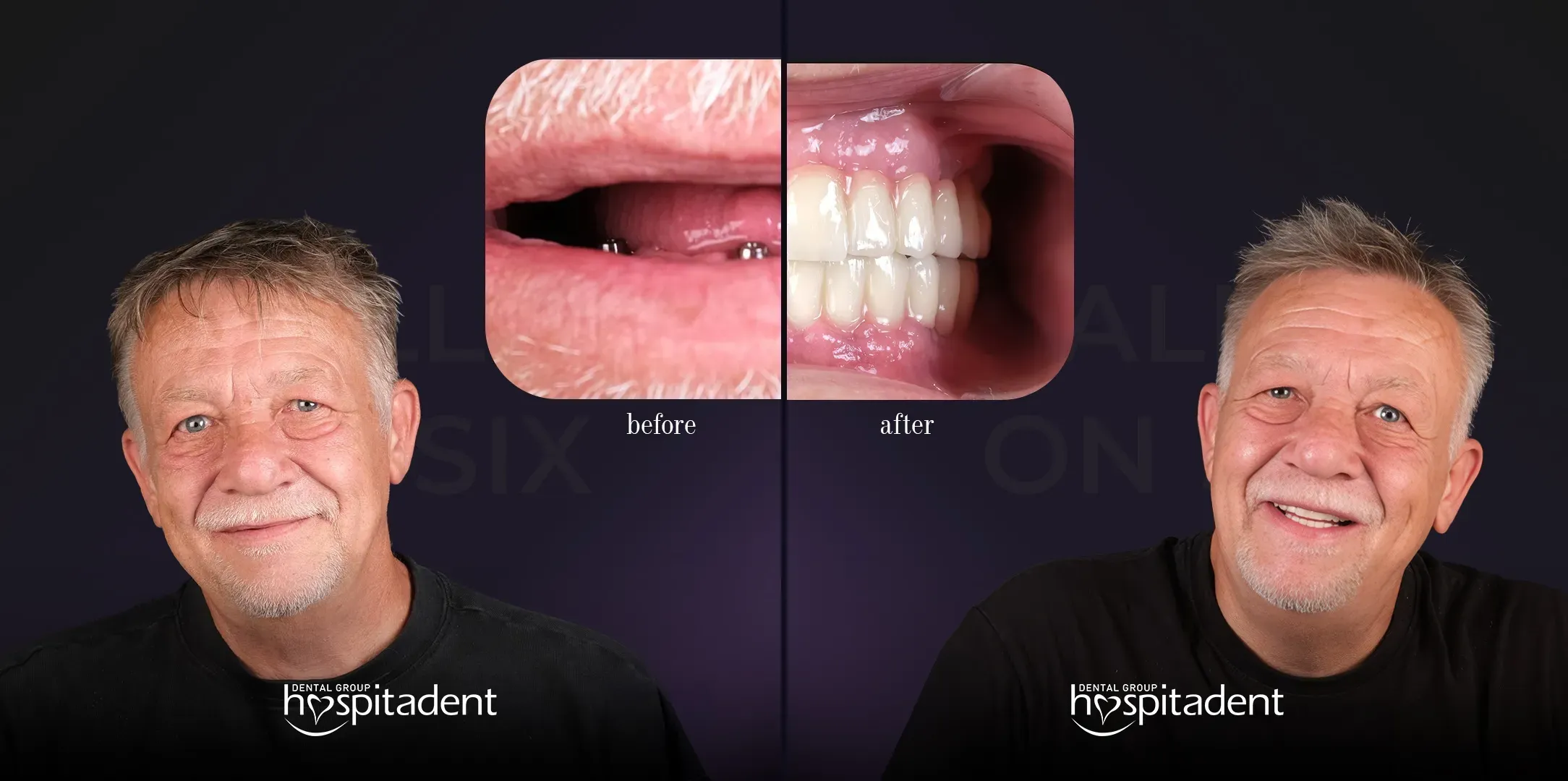 All on 6 Dental Implants: Complete Guide
