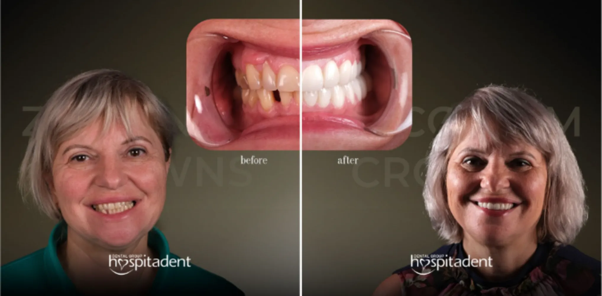 Dental Crowns Treatment: Materials, Application Steps & Safety