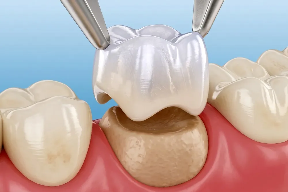 Dental Crowns