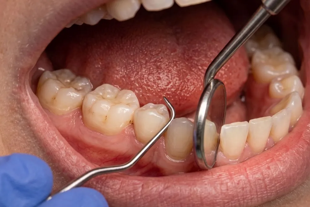 Curettage Treatment