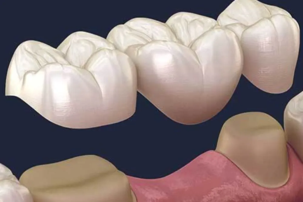 Dental Bridge