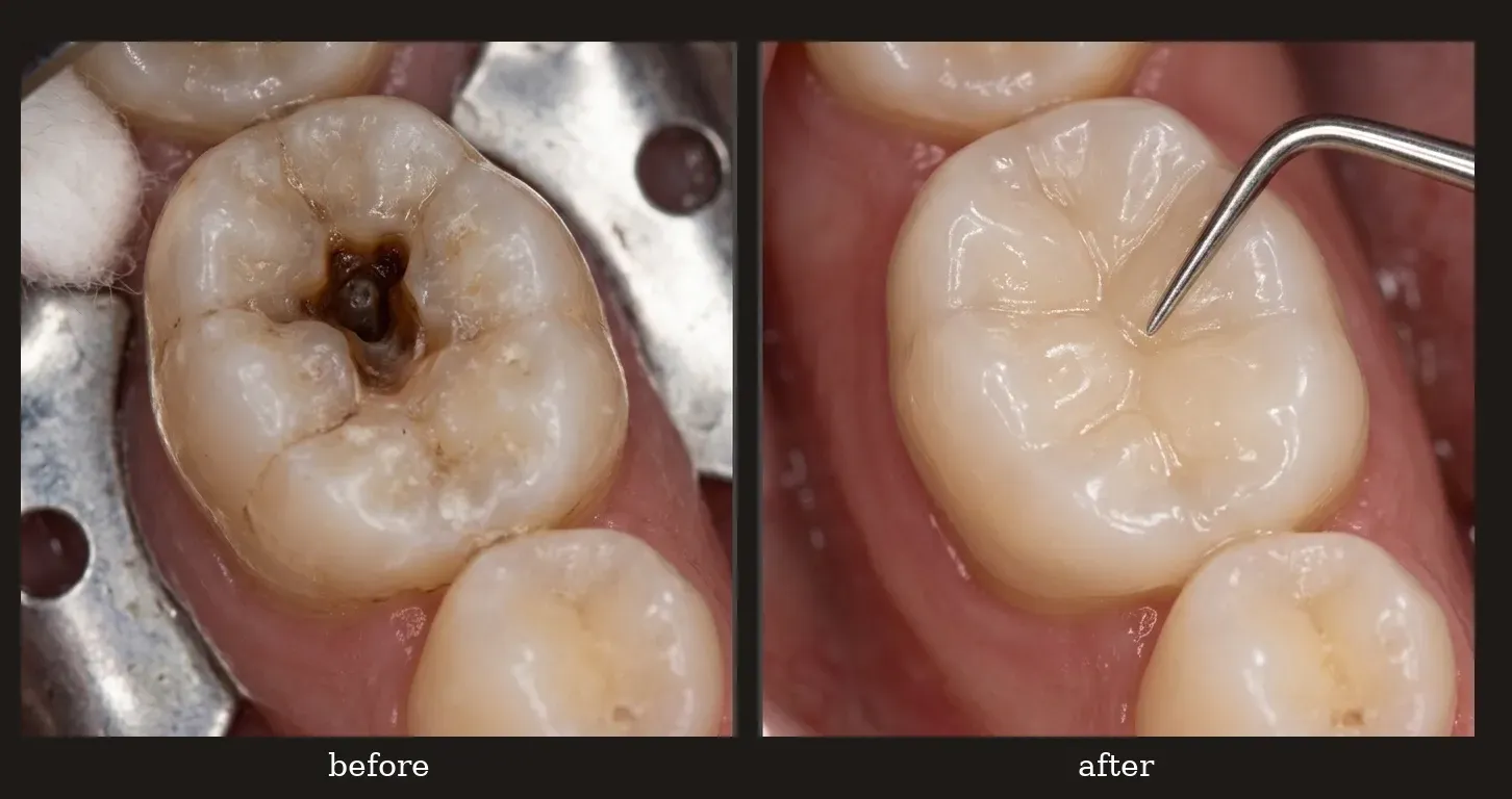 What Is a Dental Filling? How Is It Done?