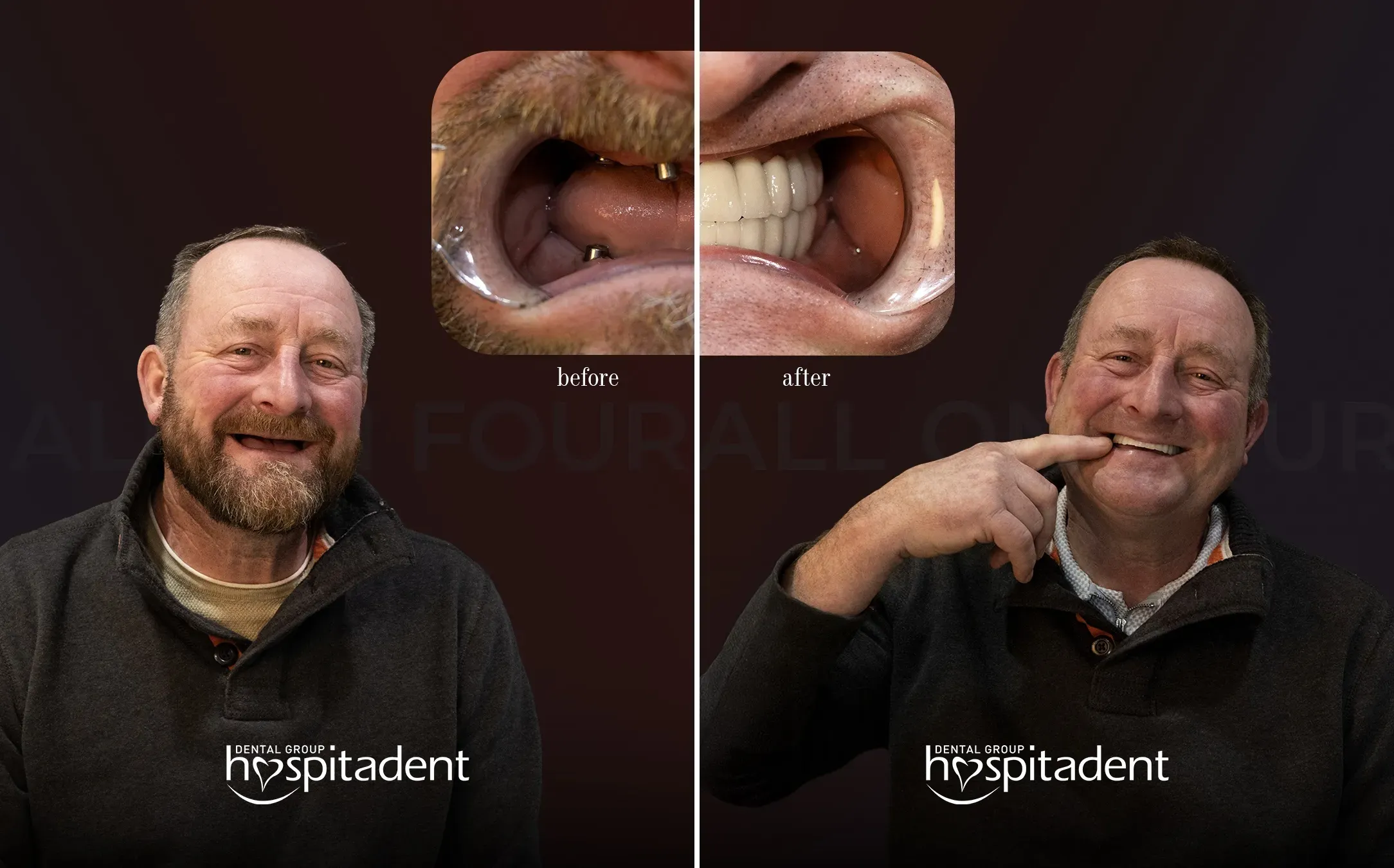 What is Dental Implant Treatment? How is it Performed?