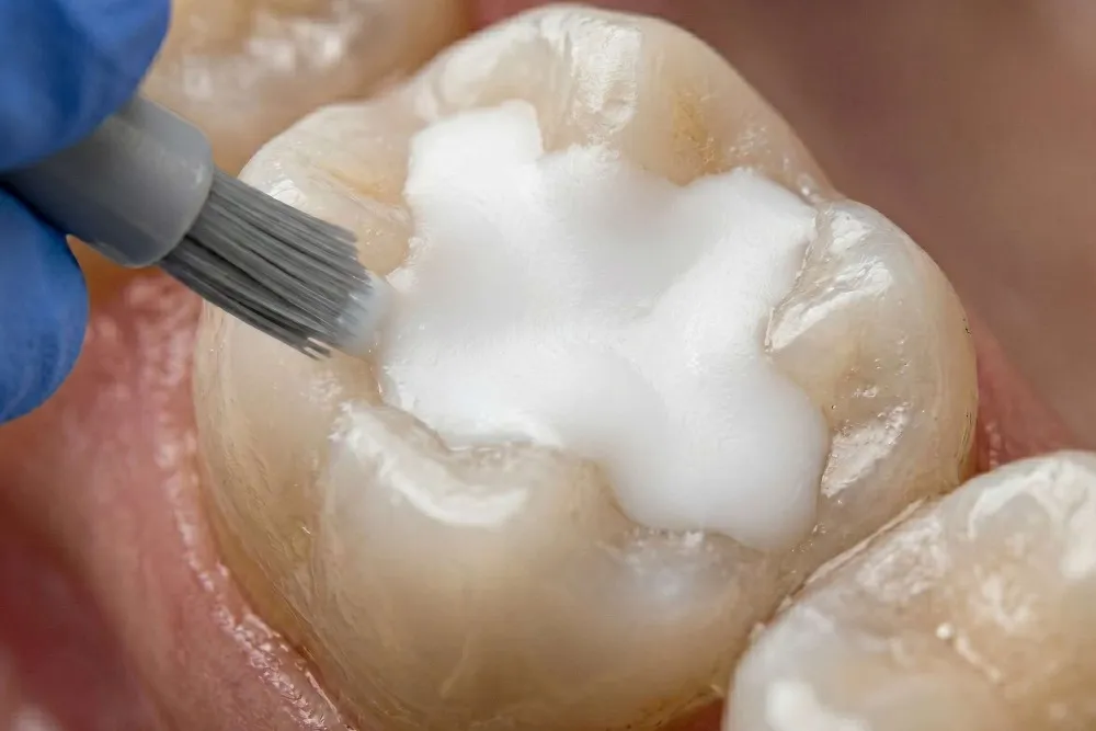 Fissure Sealant