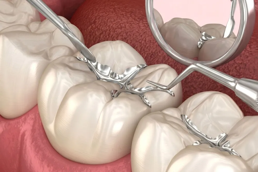 Fluoride Varnish