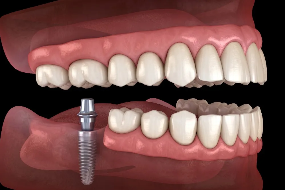 Full Mouth Implant