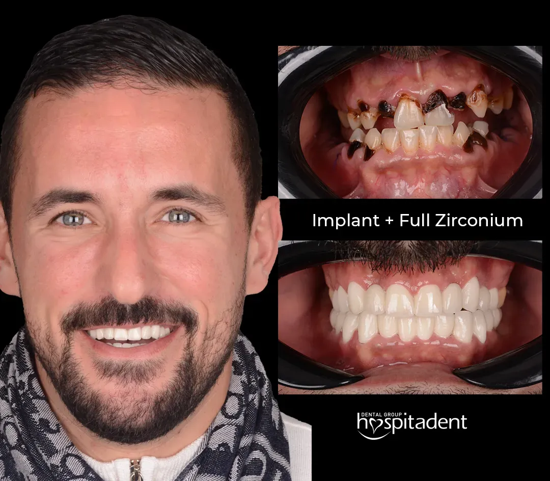 What is the Hollywood Smile Turkey Offers?
