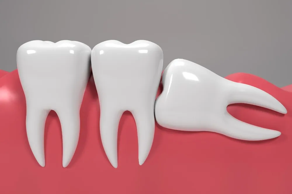 impacted tooth