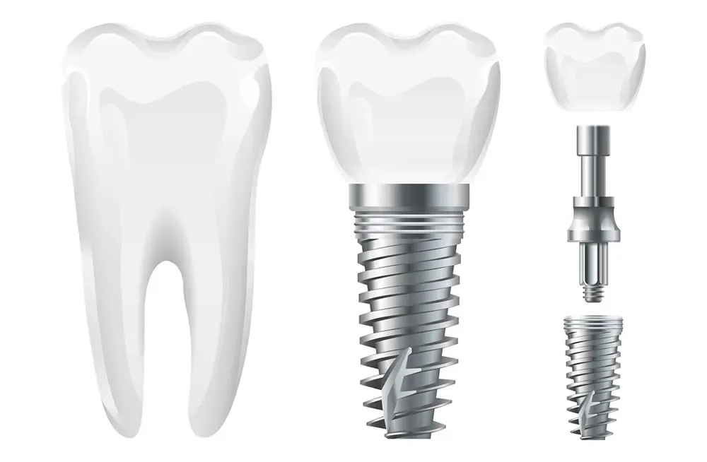 İmplant Nedir? Diş İmplantı Nasıl Yapılır?