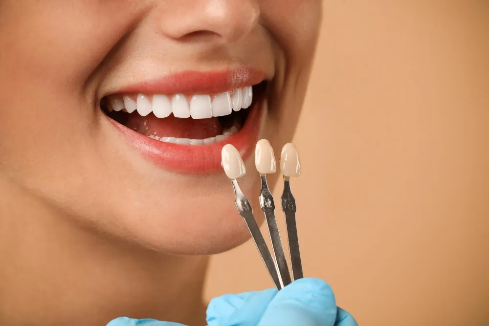 laminate veneers vs composite bonding