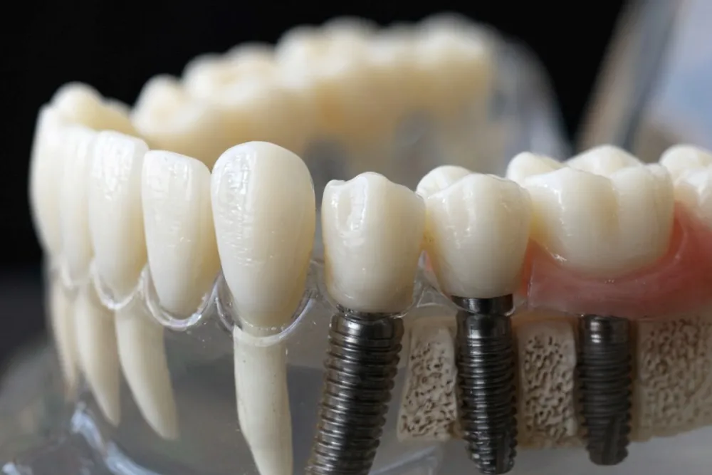 Multiple Dental Implant