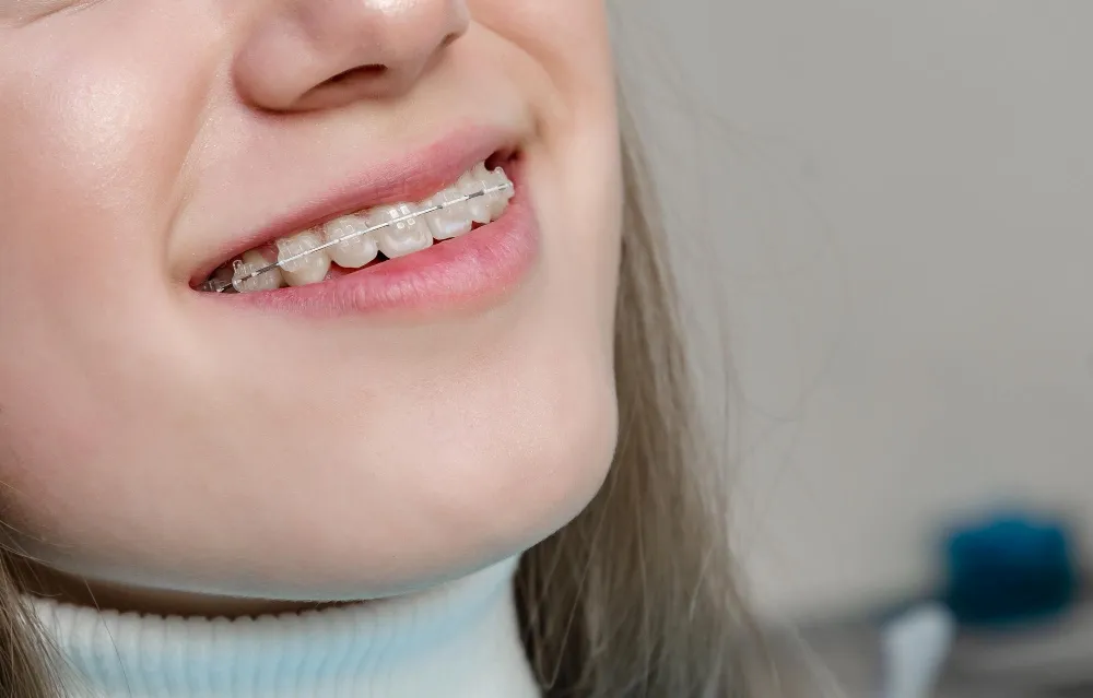 Şeffaf Braketli Tedavi Nedir? Avantajları Nelerdir?