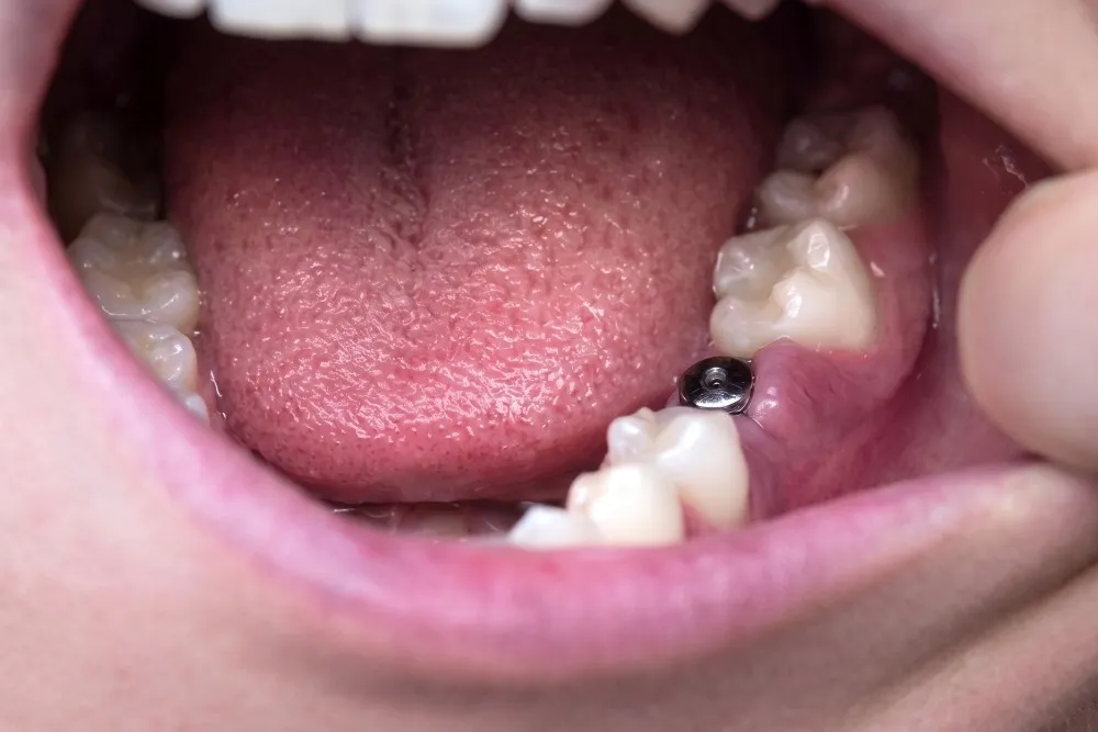 Single Tooth Implant Treatment