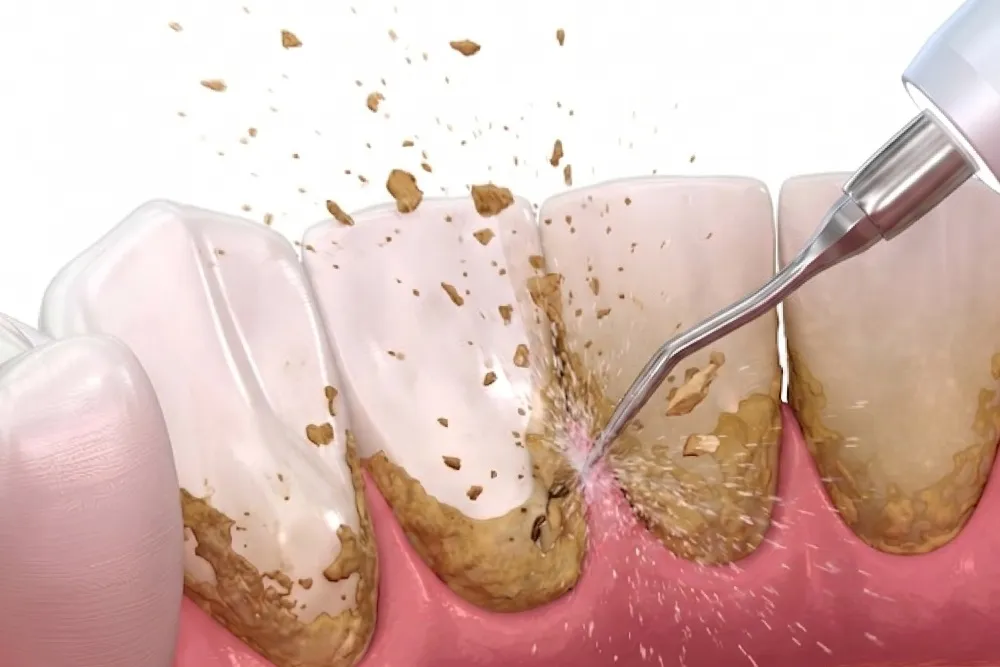 Teeth Scaling