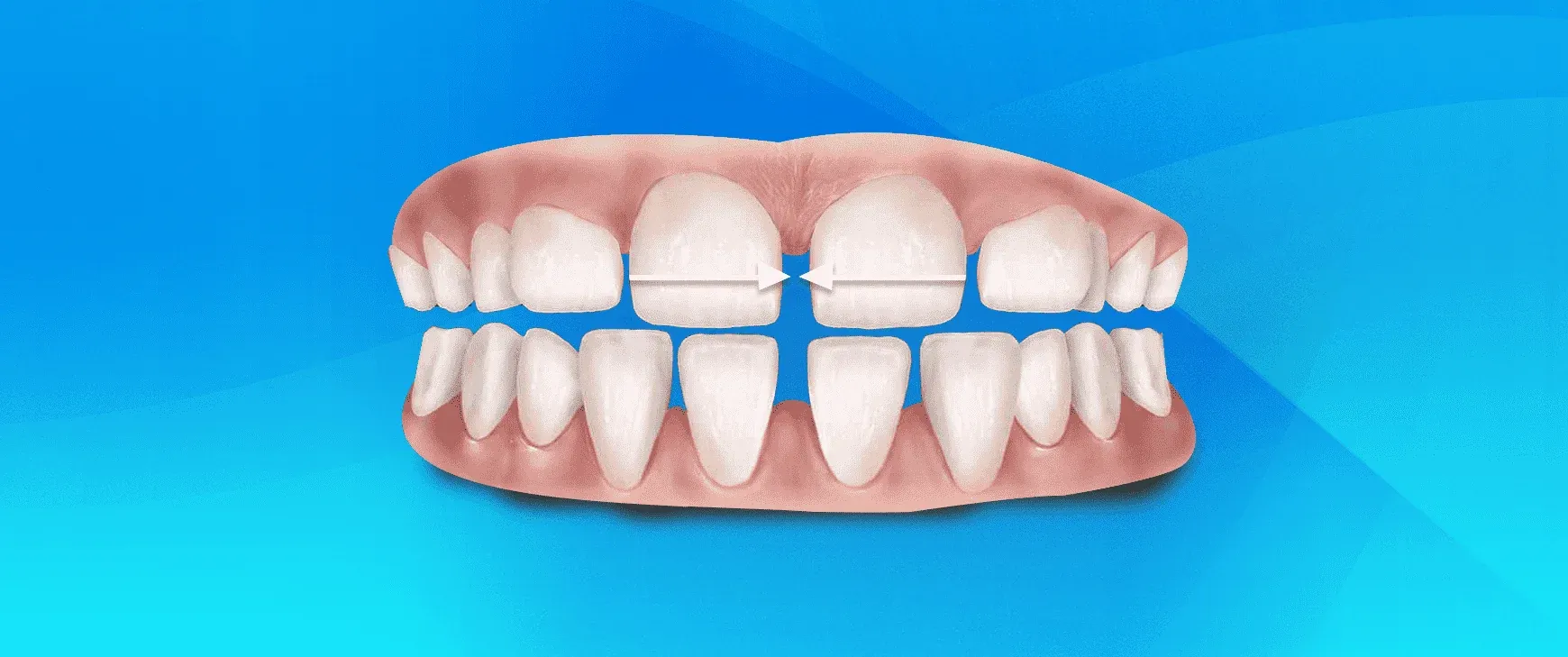 What Is Bonding Treatment? How Is It Done?