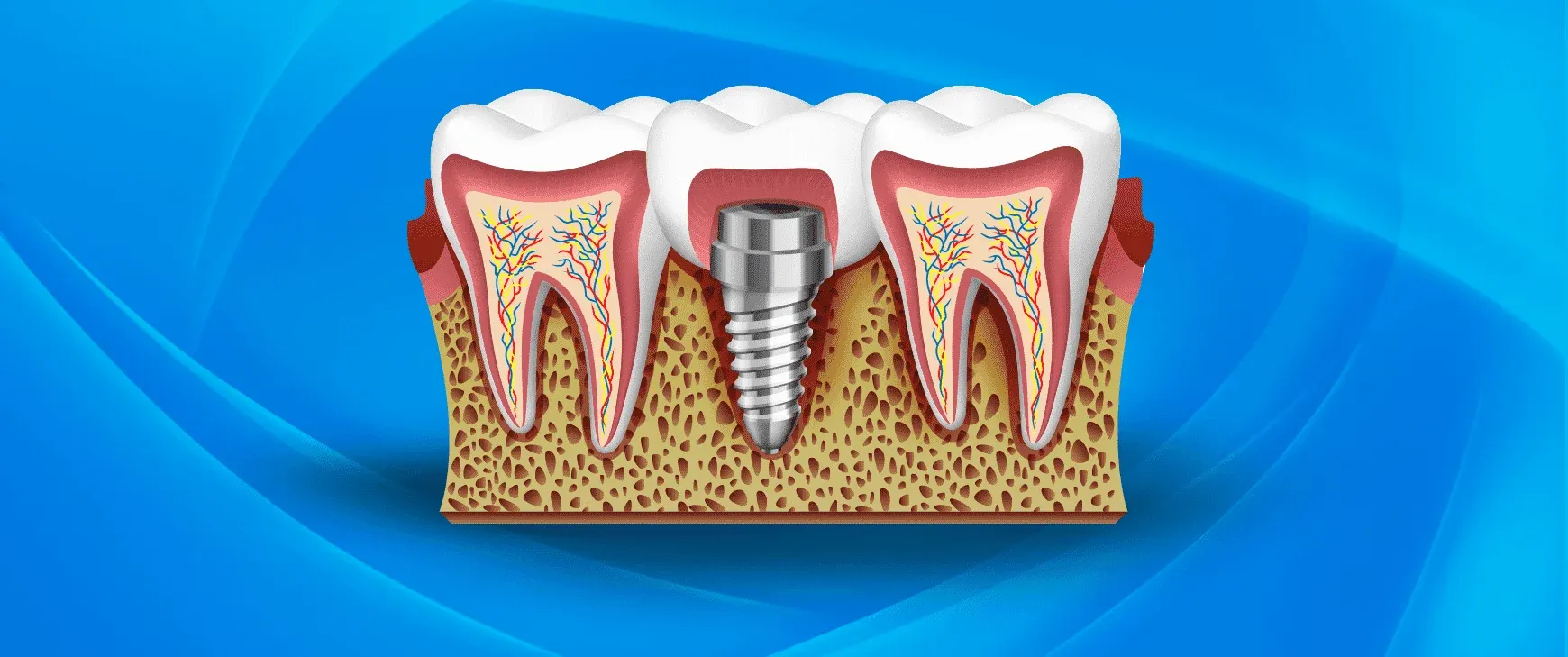 What is Box Technique? – Dental Clinics in Istanbul Turkey