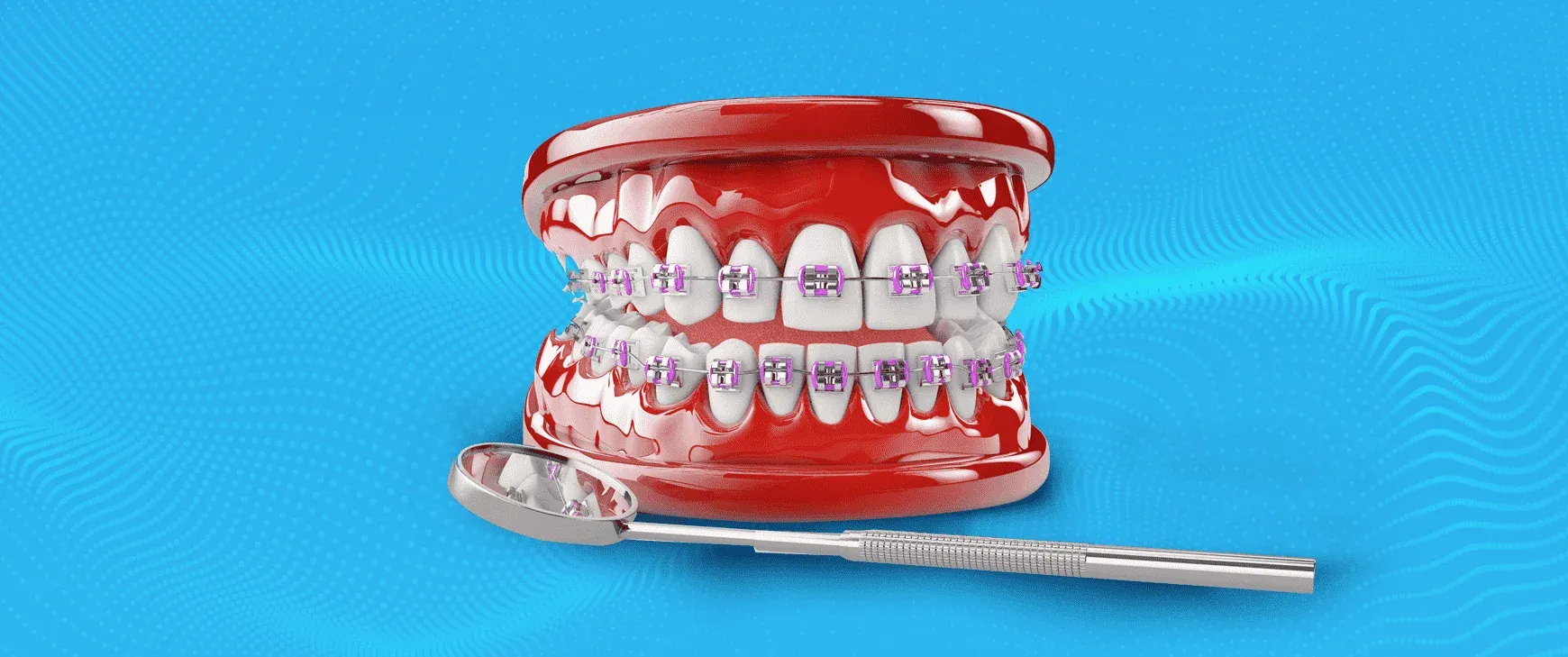 How Braces Treatment Improves Overall Dental Alignment