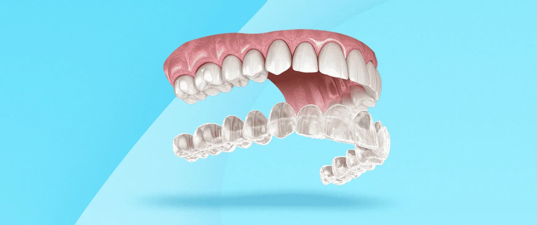 Invisalign Turkey: An Oversight of Invisalign Treatment in Turkey