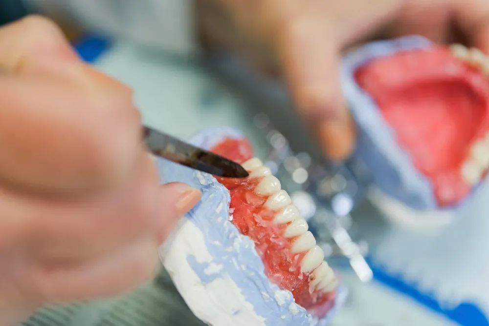 Dental Bridge