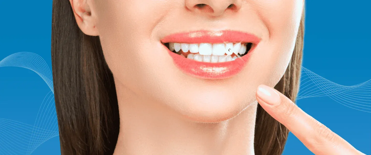 Diş Pırlantası (Diş Kristali) Nedir?