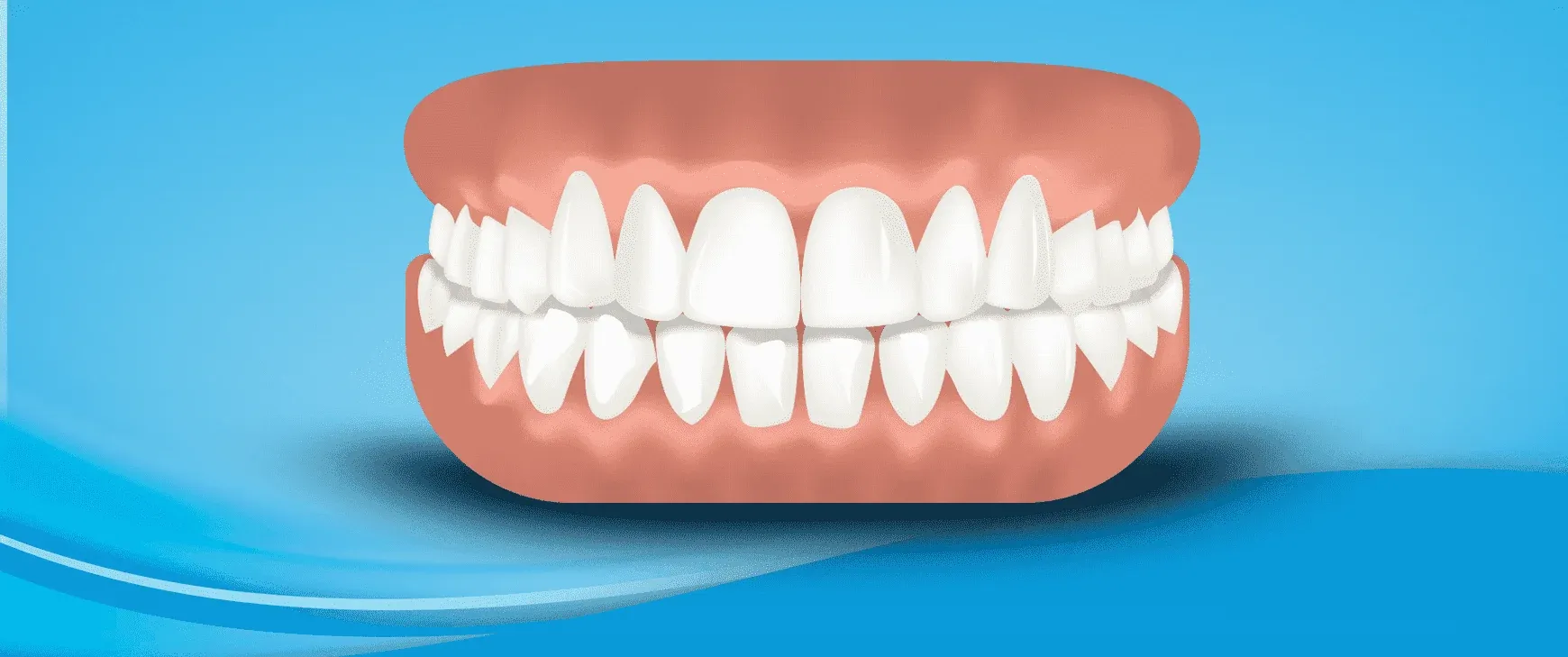 Full Mouth Implant Treatment
