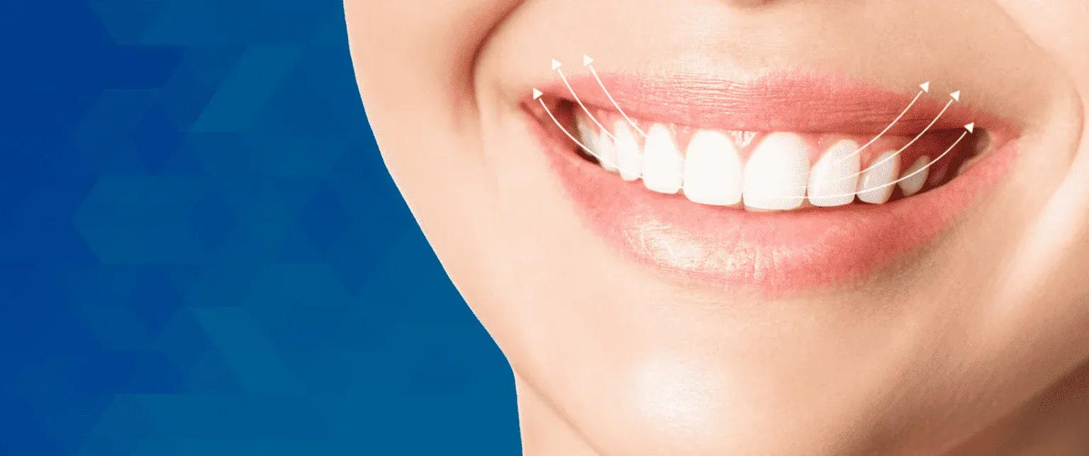 Gülüş Tasarımı (Estetiği) Nedir? Nasıl Yapılır?
