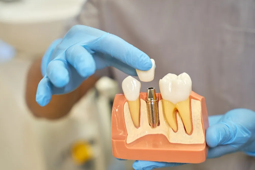 What is Dental Implant Treatment? How is it Performed?
