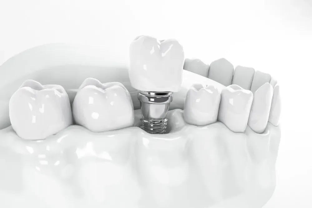 Implantes Dentales y Cuidado de Implantes