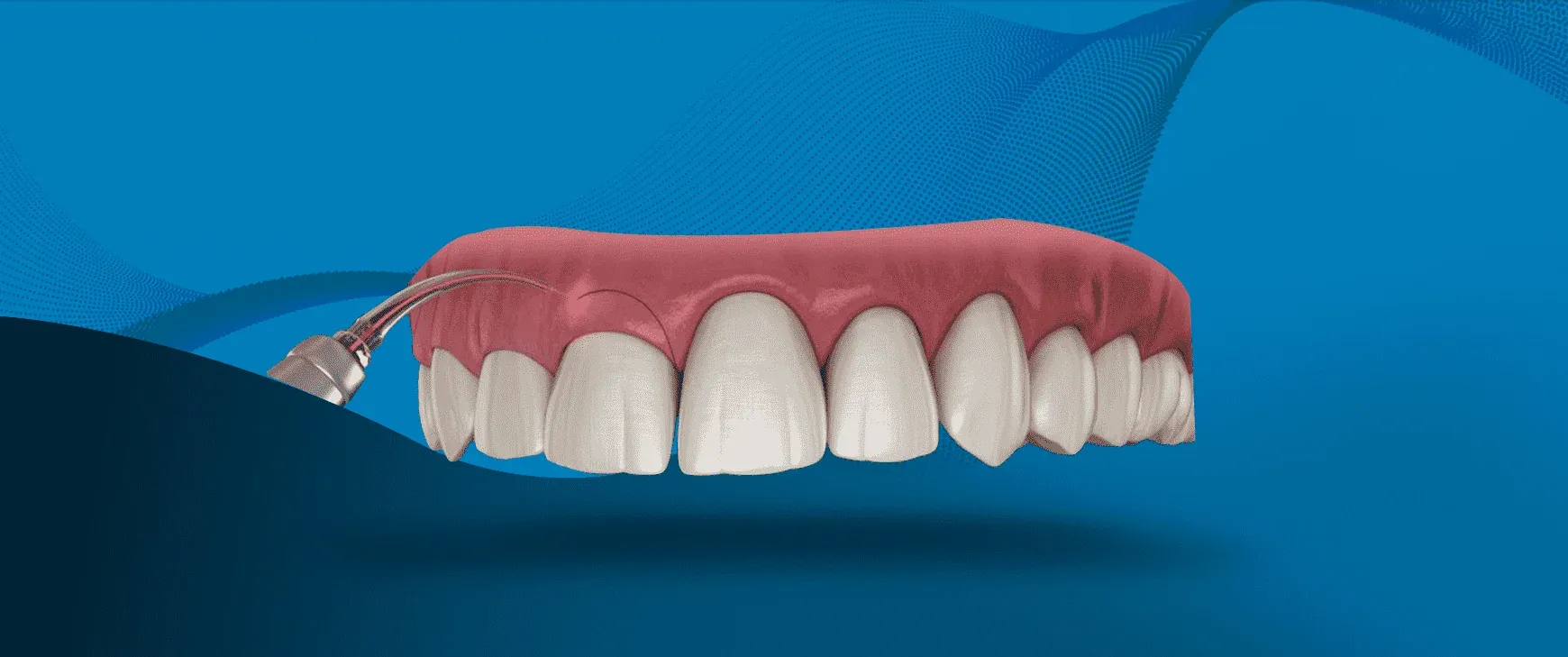 Laser Dental Treatment