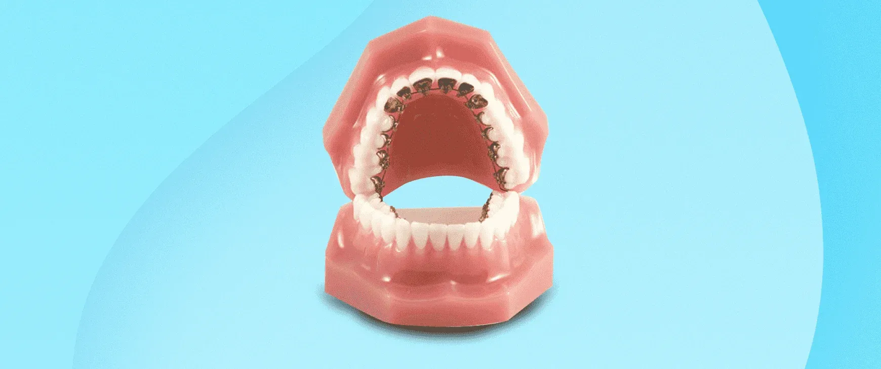 Lingual Braces Treatment