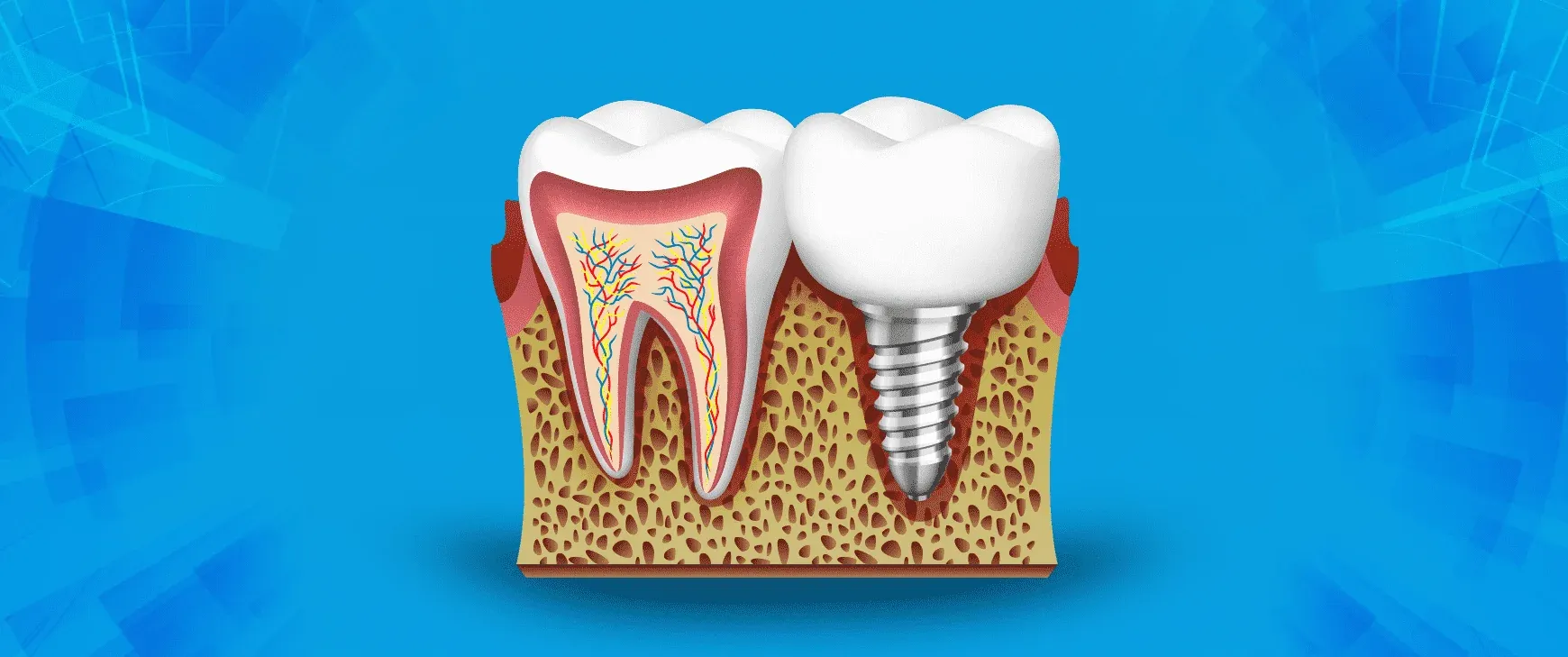 Single Tooth Implant Treatment