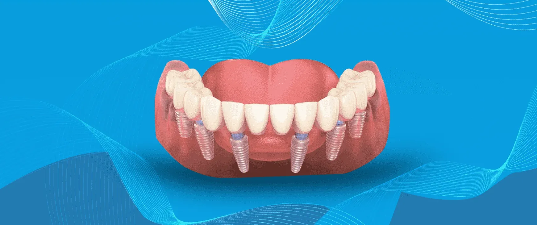 Traitement D’implant Buccal Complet