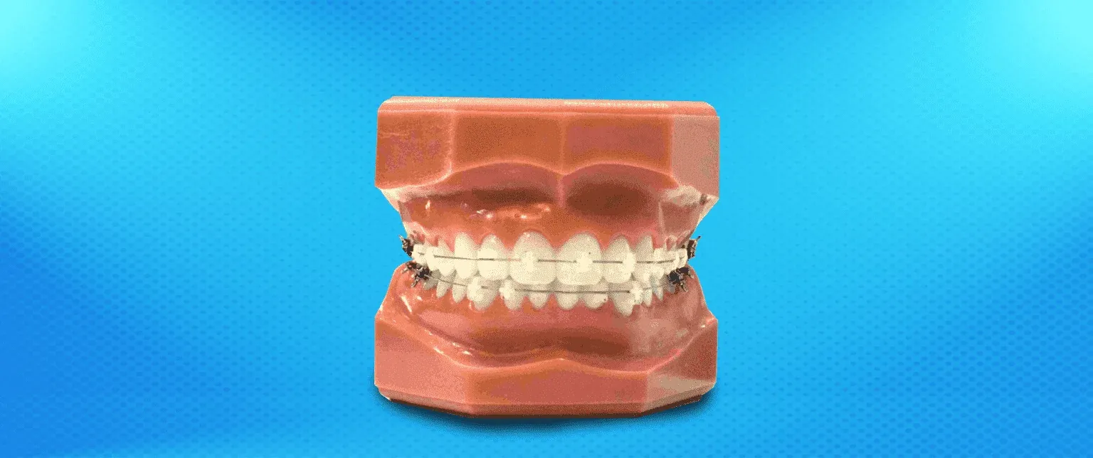 Was Sind Transparente Brackets und Wie Funktionieren Sie?