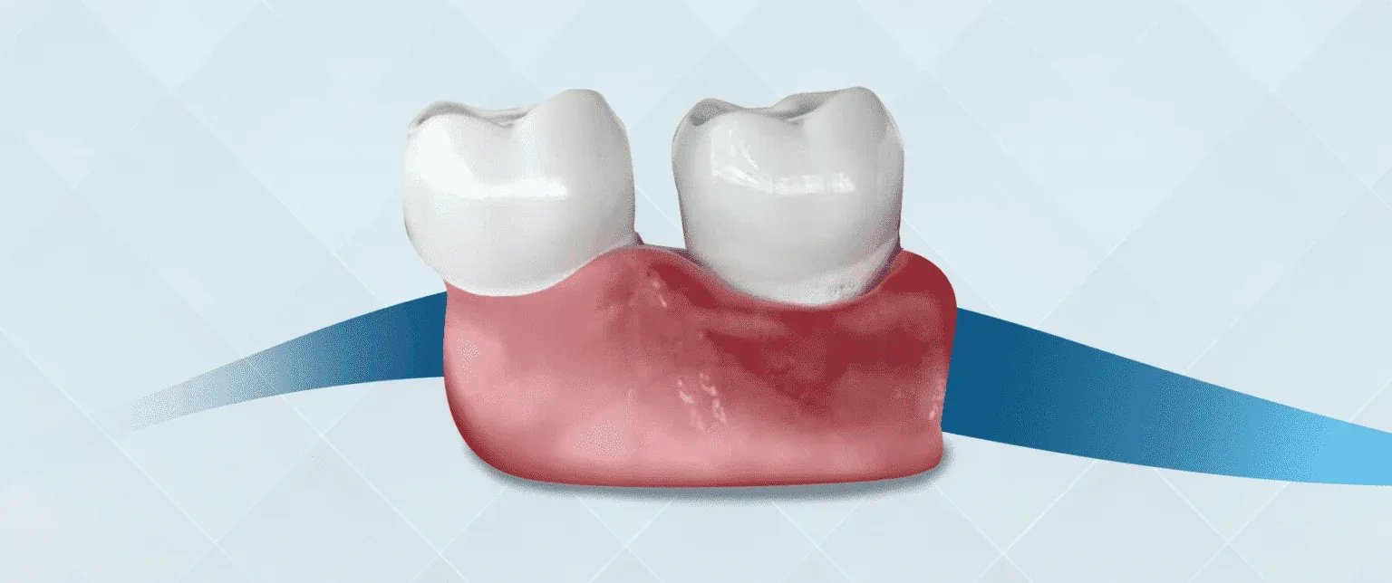 Zahnfleischentzündung (Gingivitis)